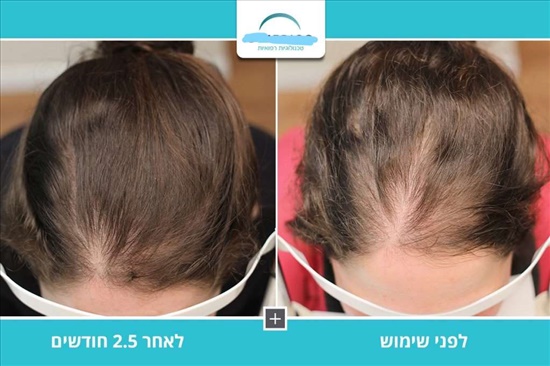 תמונה 3, hairegen למכירה באשדוד | קוסמטיקה וטיפוח  אחר